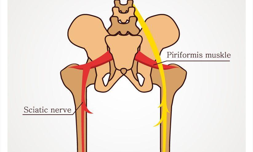 Natural Sciatica Treatments