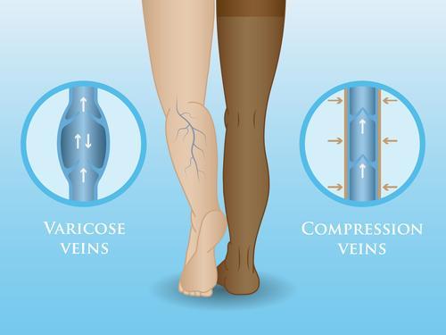 Natural Varicose Vein Treatments