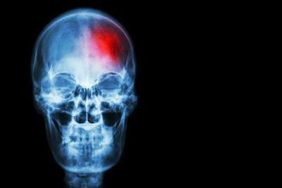 Cómo identificar un derrame cerebral en 3 sencillos pasos